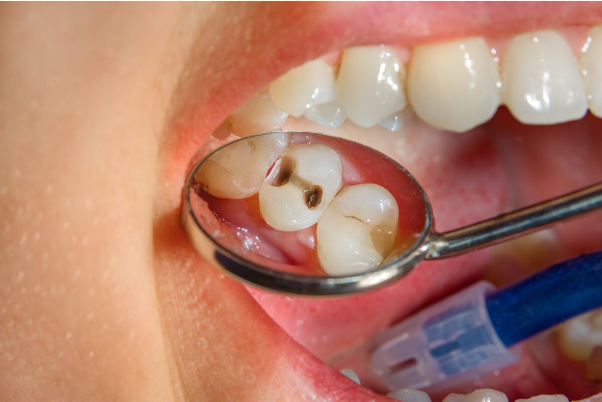 تسوس الأسنان كمضاعفات لثقب الأسنان.