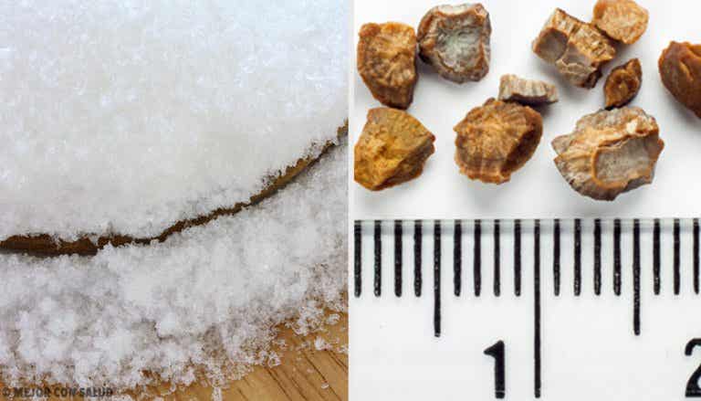 7 علاجات منزلية لطرد حصوات الكلى