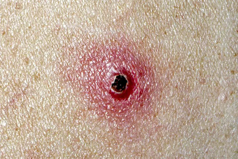 أعراض حمى خدش القط وعلاجها