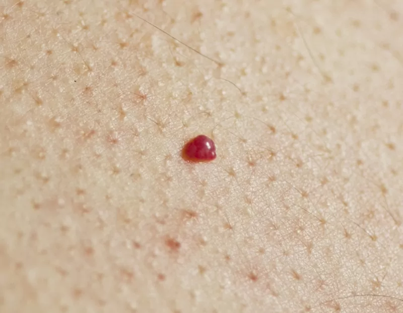 الشامات الحمراء على الجلد