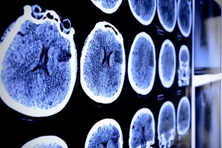 ما هو الورم النجمي وكيف يمكن علاجه؟