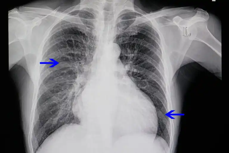 ما هو تضخم القلب ولماذا يحدث؟