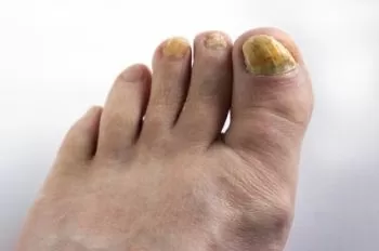 علامات فطريات أظافر القدم