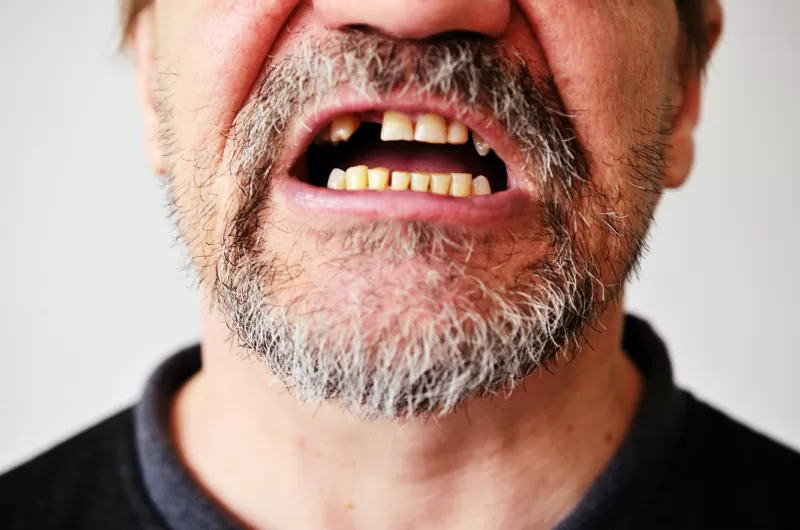 ماذا يعني سقوط الأسنان في المنام؟