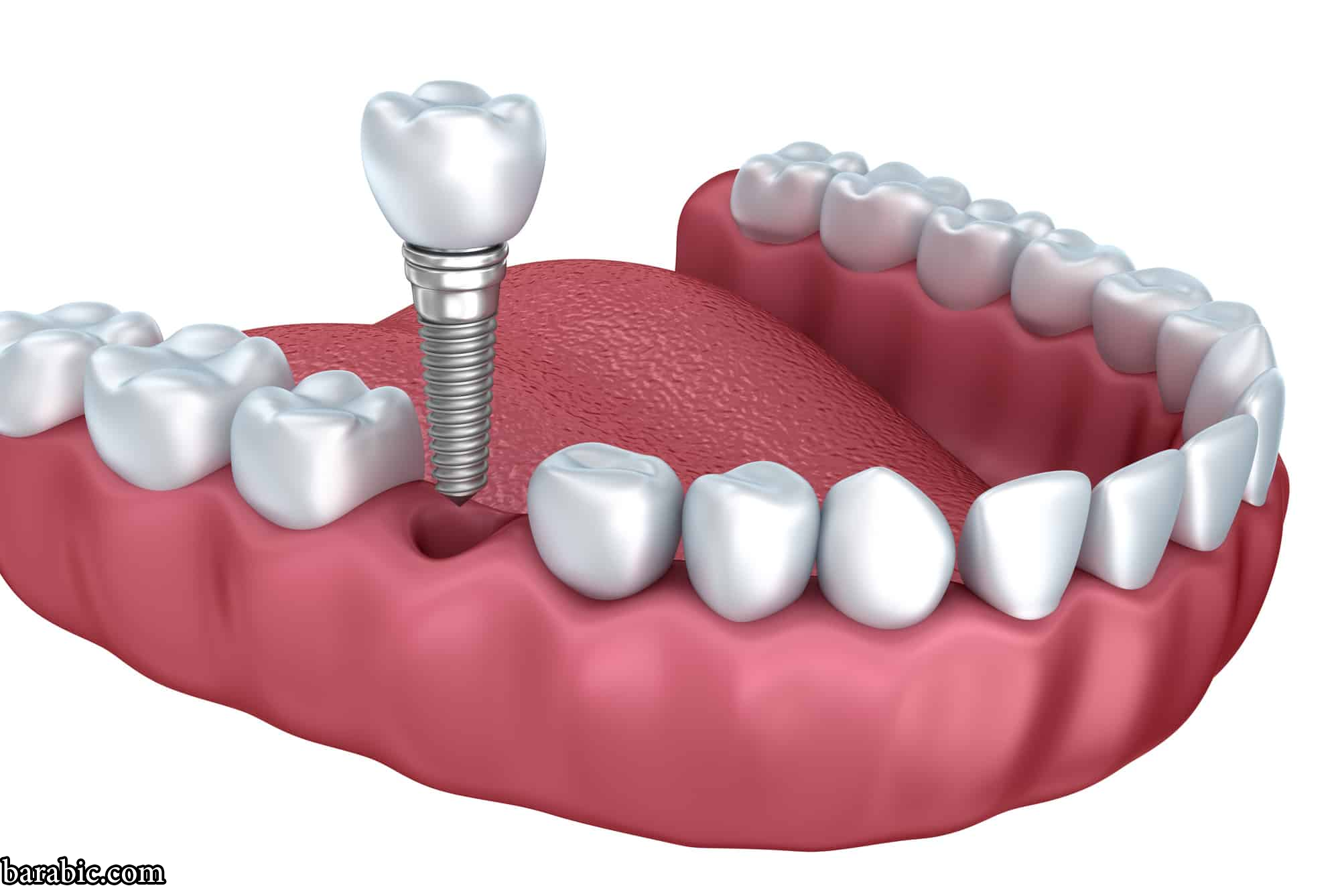 أنواع زراعة الأسنان المميزات والعيوب