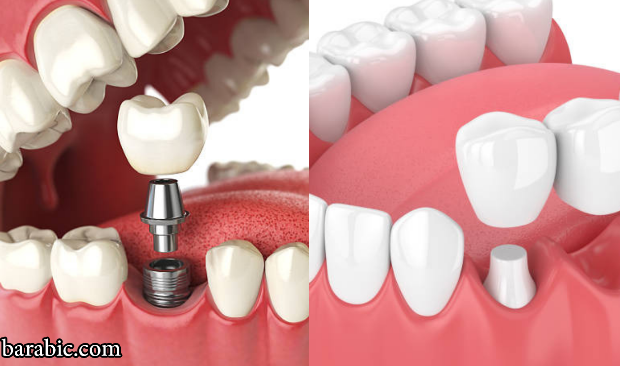جسور الأسنان مقابل الغرسات: مقارنة بين التكاليف والفوائد