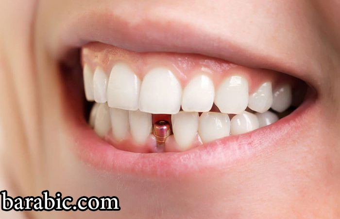 8 مشاكل زراعة الأسنان وأسباب الفشل