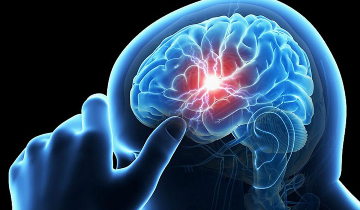 الإسعافات الأولية للسكتة الدماغية تمنع مضاعفات خطيرة