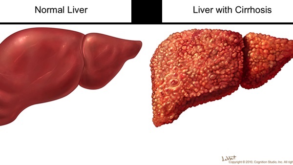 التليف الكبدي … اسبابه، اعراضه، علاجه