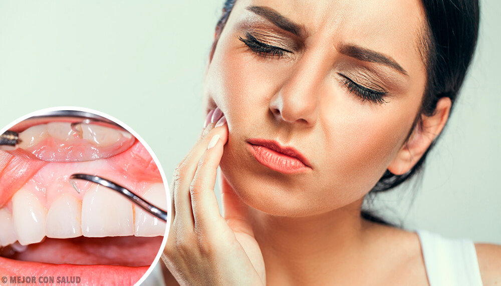 كل ما تحتاج إلى معرفته عن التهاب اللثة