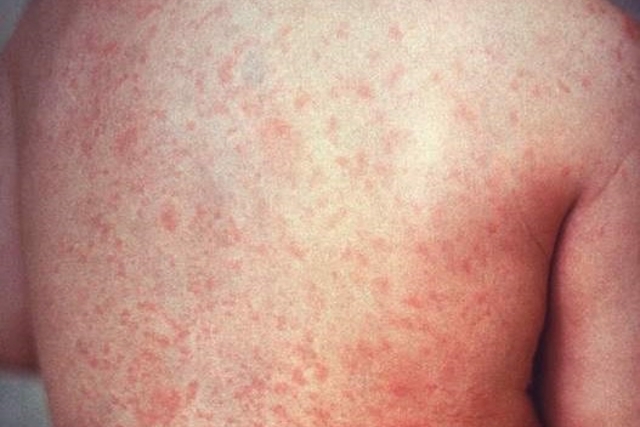 7 أمراض تسبب بقعًا حمراء على الجلد